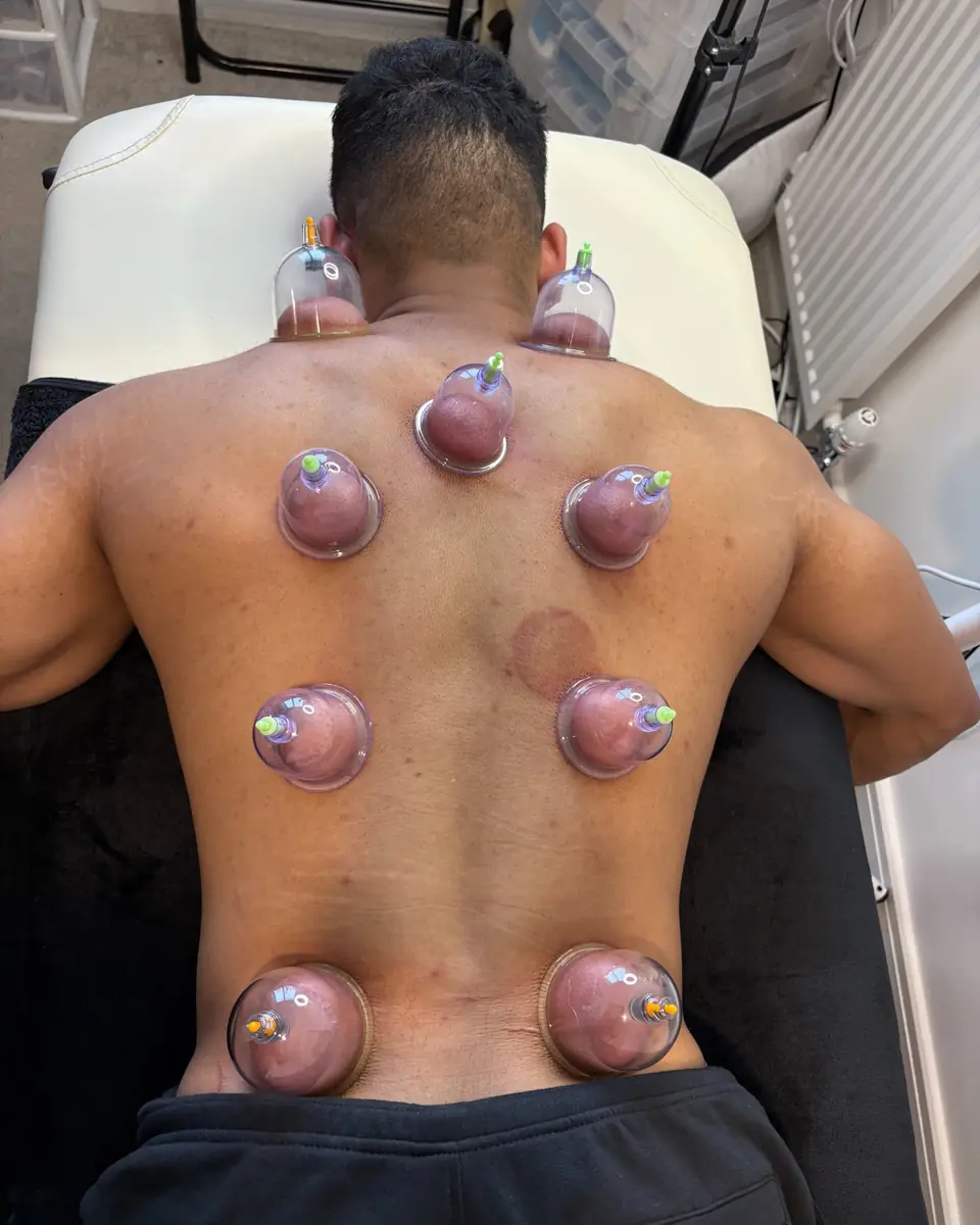 Wet cupping (hijama) cups on a client's back at Glow By Yaz