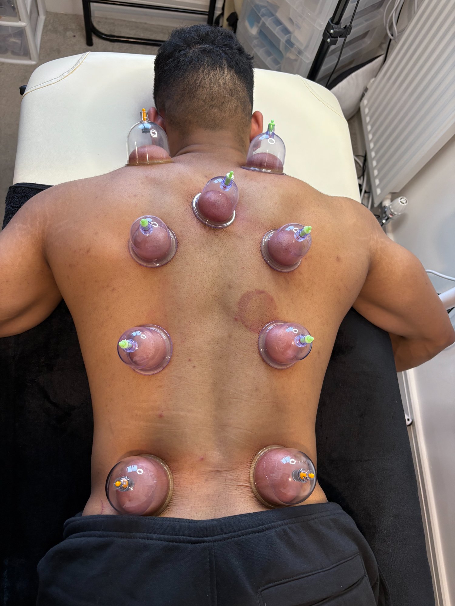 Cupping Therapy