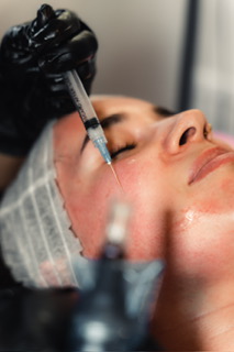 Microneedling Procedure