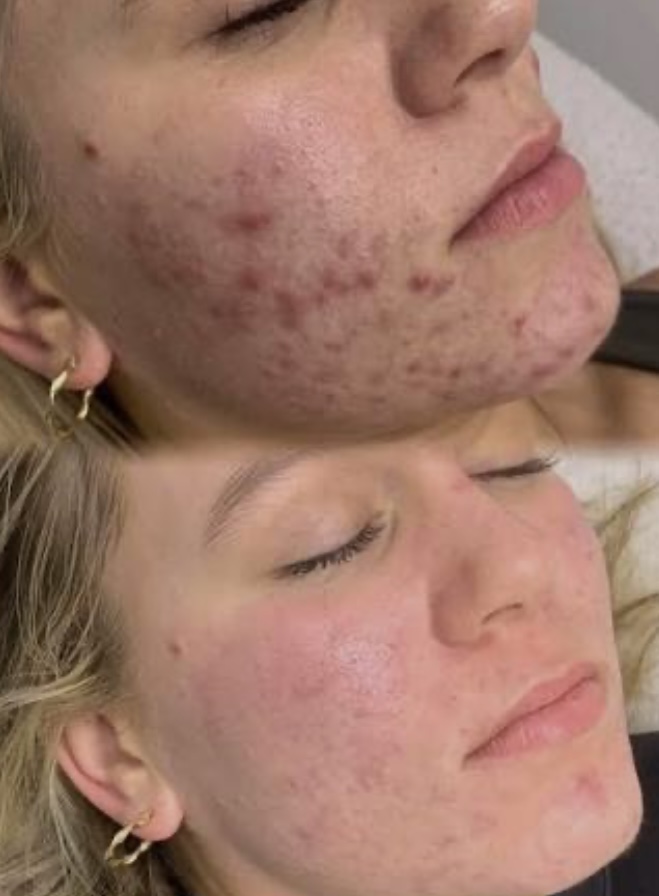 Before After Treatment